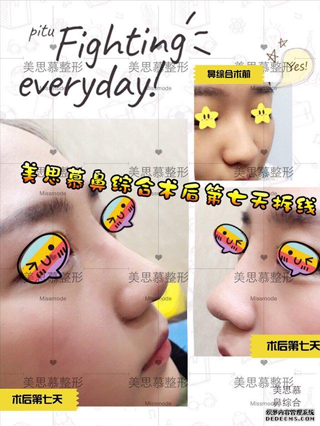用自己身上的“材料”去整形，耳软骨隆鼻案例耳软骨隆鼻加假体吗