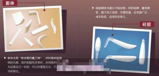 鼻子如果做假体，到老咋整，需要取出吗？-硅胶隆鼻是不是永久的呢