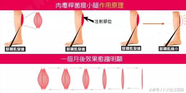 注射除皱，玻尿酸和肉毒素这么打，效果更好！-玻尿酸除皱针好不好打