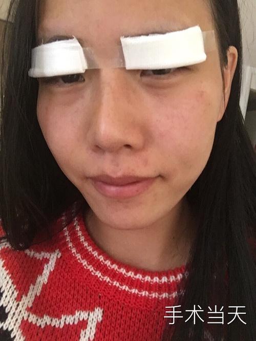 韩式三点双眼皮，大家觉得怎么样