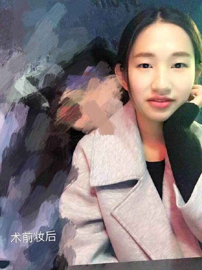 韩式三点双眼皮，眼睛大了看起来精神多了-割双眼皮三点式是什么样的