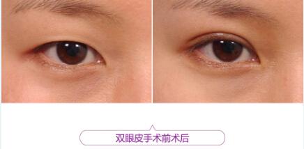 给自己点耐心：双眼皮术后一定要有一段恢复期！-全切双眼皮多久伤口不红了