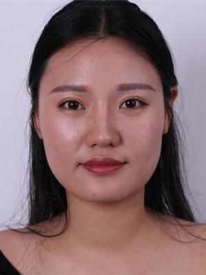 玻尿酸填充下巴后，准备存钱去做一个永久性的啦-玻尿酸填充下巴以后注意事项