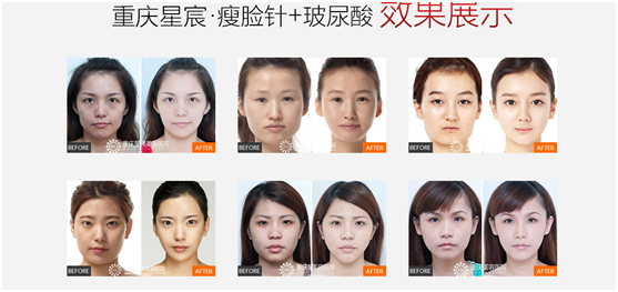 瘦脸针多少钱一次？-打瘦脸针一般的多钱