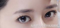 曝光！双眼皮手术整形价格！割双眼皮埋线价格多少一次
