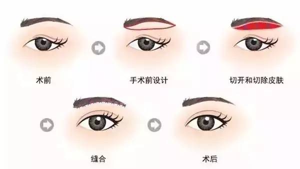 图解切眉的几种方法-切眉还是割双眼皮