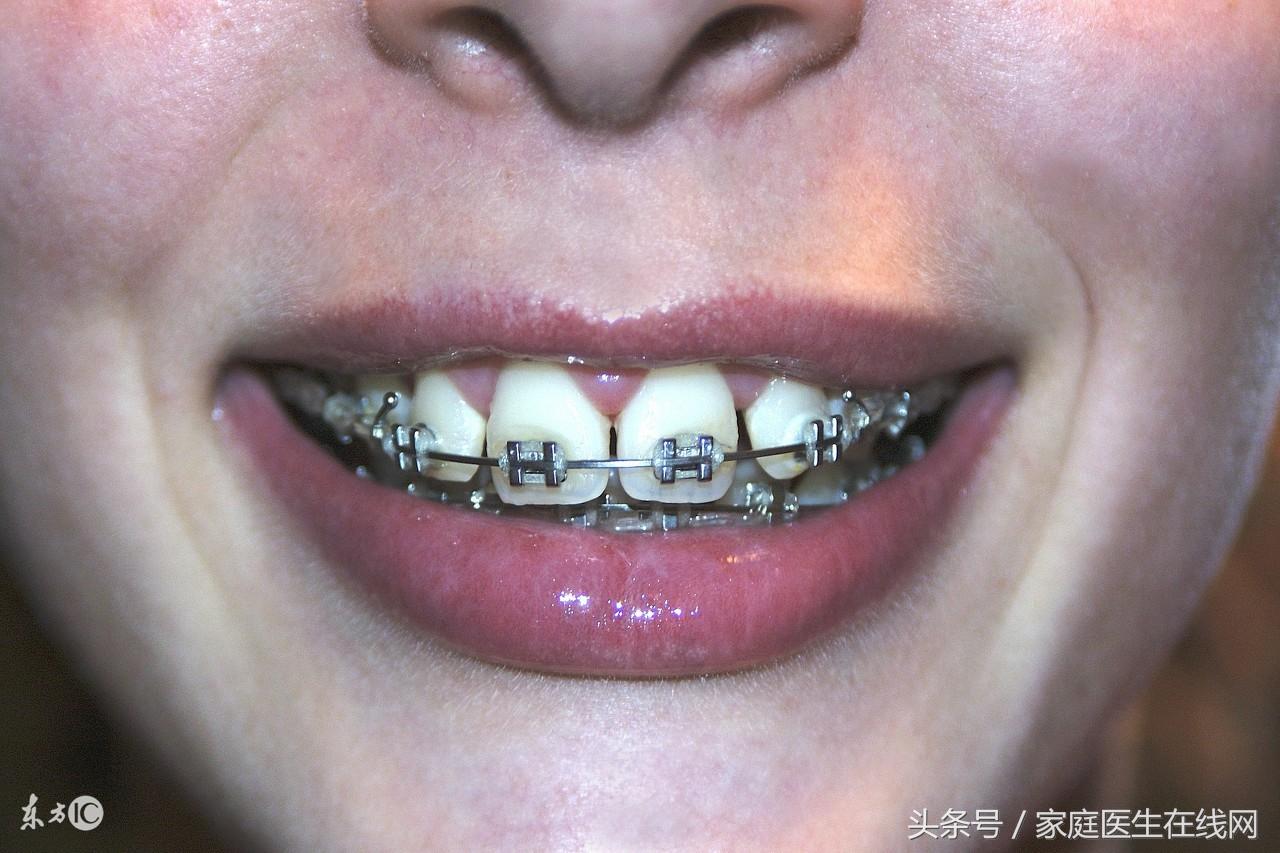 成年了还能做牙齿矫正吗？没有这一个问题就行！-成人牙齿矫正要多少钱？