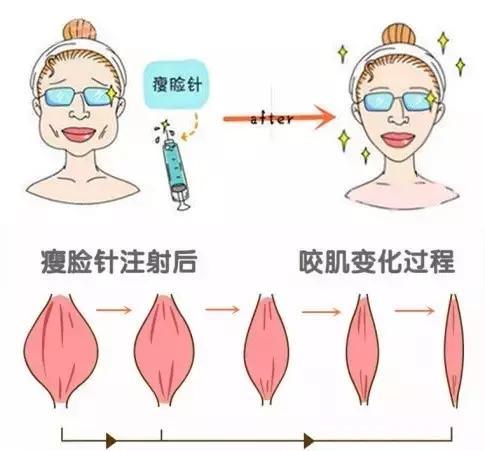 为啥你打了瘦脸针没效果？打瘦脸针注意事项-瘦脸针起效果后可以热敷吗