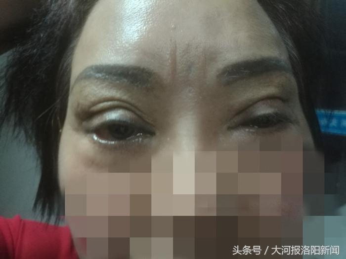 她想美容结果被毁容：到洛阳协和修复双眼皮，却被割成了三眼皮！