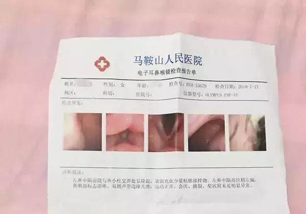 安徽女子花2万多隆鼻，总能闻到臭味！竟从鼻腔里取出一长条纱布-耳鼻骨隆鼻有效期是多久