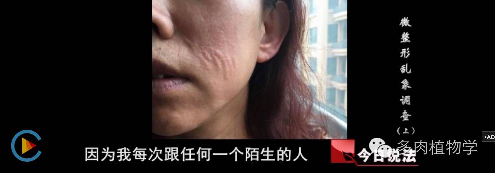 非法注射微整形，到底害惨了多少人？-打瘦脸针有没有什么危害呢视频