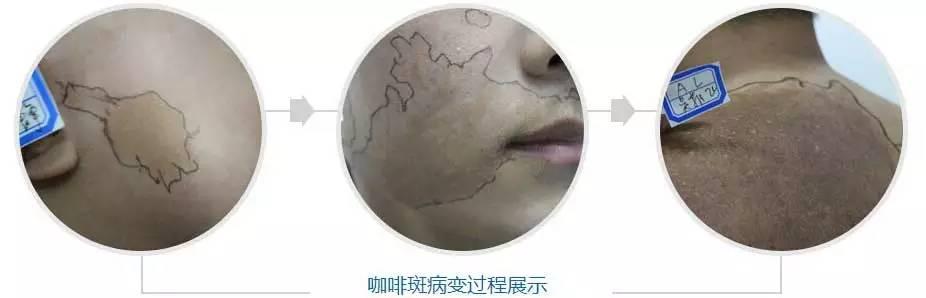 宝宝胎记和黑痣的区别，嘟嘟妈教你快速识别宝宝身上的鹤吻痕、胎记、胎痣、血管瘤哦