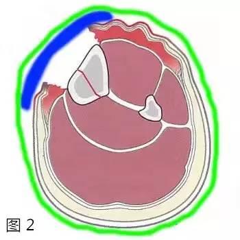 伤口包扎的正确步骤图，一个每人都要知道的小