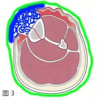 伤口包扎的正确步骤图，一个每人都要知道的小