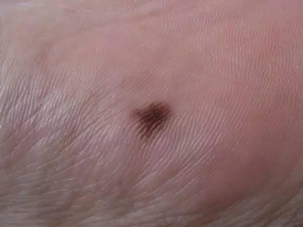宝宝胎记和黑痣的区别，嘟嘟妈教你快速识别宝宝身上的鹤吻痕、胎记、胎痣、血管瘤哦