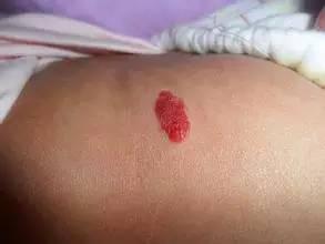 宝宝胎记和黑痣的区别，嘟嘟妈教你快速识别宝宝身上的鹤吻痕、胎记、胎痣、血管瘤哦
