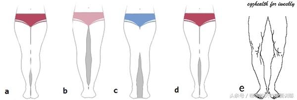 如何快速有效矫正o型腿，帮你轻松告别O型腿