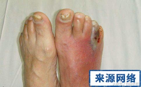 糖尿病并发症眼睛疼(糖尿病并发症眼睛看不见怎么治疗)
