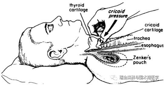 环状软骨和勺状软骨，扒一扒环状软骨压迫那些事儿
