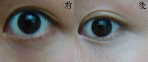 如何快速去除黑眼圈，如何真正有效去除黑眼圈（去除黑眼圈最快速有效的方法都在这里了）
