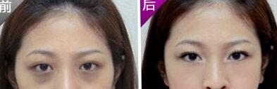 如何快速去除黑眼圈，如何真正有效去除黑眼圈（去除黑眼圈最快速有效的方法都在这里了）