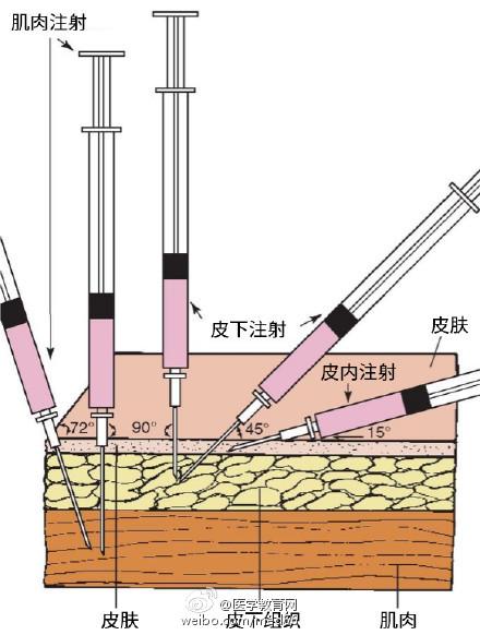 肥胖病人静脉穿刺技巧(肥胖病人静脉穿刺)