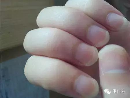 灰指甲是什么样子，灰指甲常见的种类有哪些（轻微的灰指甲是什么样子图示）