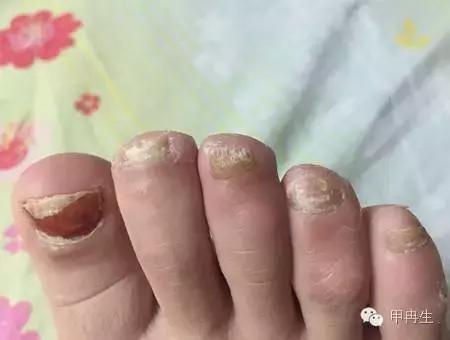 灰指甲是什么样子，灰指甲常见的种类有哪些（轻微的灰指甲是什么样子图示）