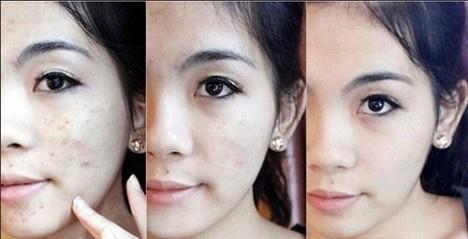 白醋祛痘最有效的偏方，这些祛痘的偏方太有用了