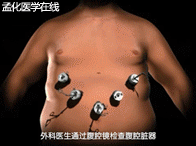 糖尿病胃旁路(糖尿病胃旁路微创手术是什么意思)