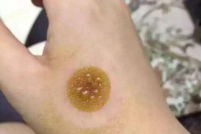 艾灸后可能会出现的十种症状，艾灸后出现的这些“不良反应”