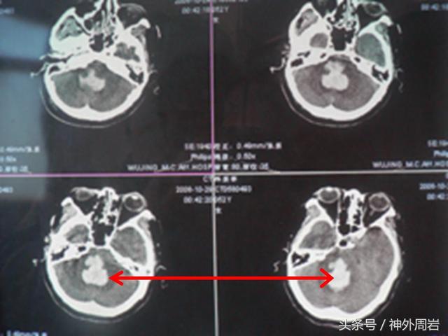 脑干出血死亡事件，女子突发脑干出血被诊断为“脑死亡”她走了为5人带来了新生