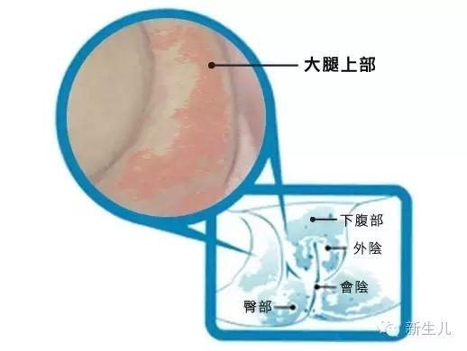 新生儿皮肤起红疹子怎么办，宝宝发烧出疹子