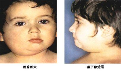 流行性腮腺炎的主要症状是什么，小儿流行性腮腺炎有什么症状