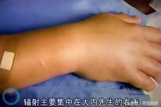 核辐射对人的伤害，核辐射对人类的危害有多大