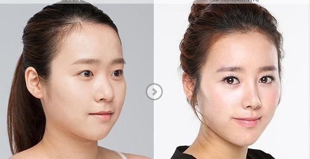 什么叫隆鼻，关于隆鼻最详细的介绍