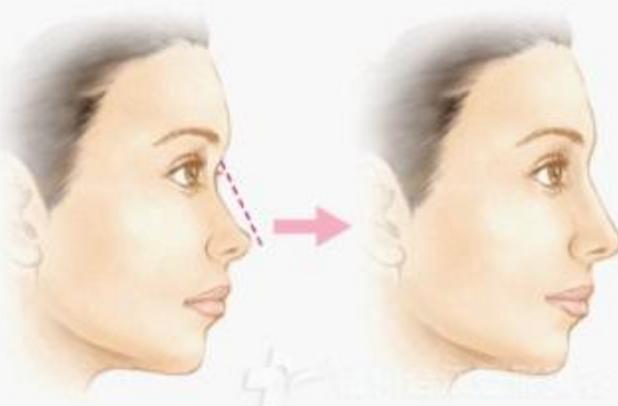 什么叫隆鼻，关于隆鼻最详细的介绍