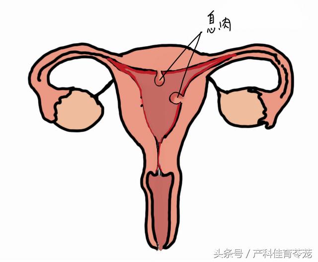 糖尿病长息肉(糖尿病长息肉严重吗)
