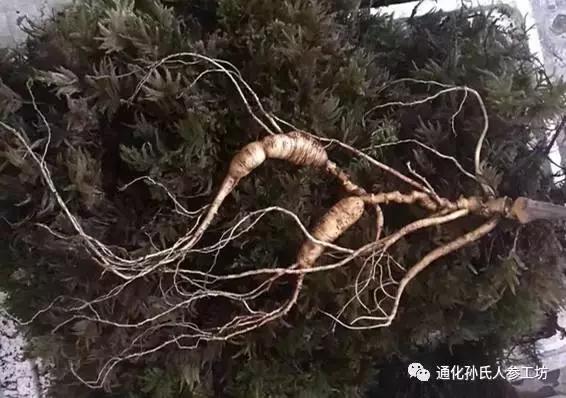 糖尿病气阻(糖尿病气胸)
