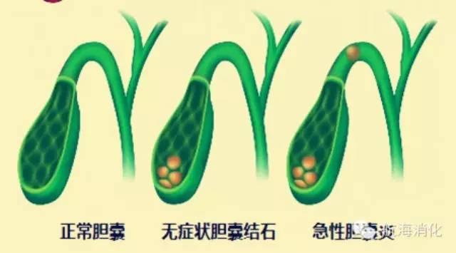 胆囊结石最佳治疗方法，胆囊结石有几种治疗方法（被查出胆囊结石应该怎么办）