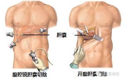 胆囊结石最佳治疗方法，胆囊结石有几种治疗方法（被查出胆囊结石应该怎么办）