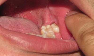 智齿什么年龄段会长，拔过智齿的地方为什么还会长智齿（日常科普——智齿是什么年龄段会长呢）