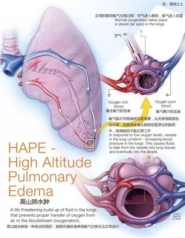 高原反应症状及处理方法，高原反应的症状及治疗（高原健康知识）