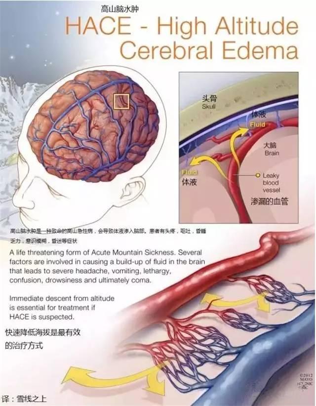 高原反应症状及处理方法，高原反应的症状及治疗（高原健康知识）