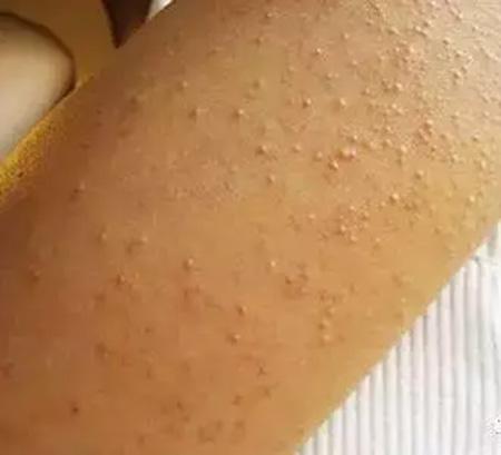 头皮毛囊炎糖尿病(头皮毛囊炎 糖尿病)