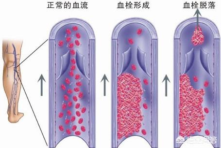 长期卧床的并发症，长期卧床常见的并发症（长期卧床，小心躺着“中枪”）