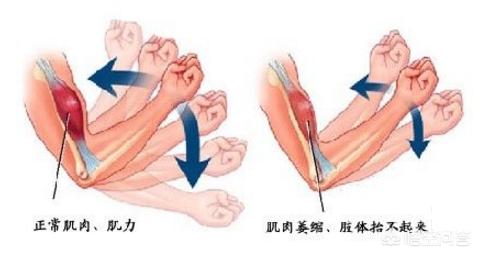 长期卧床的并发症，长期卧床常见的并发症（长期卧床，小心躺着“中枪”）