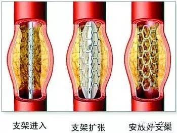 糖尿病冠心病心脏搭桥(糖尿病冠心病心梗后会有侧支循环吗)