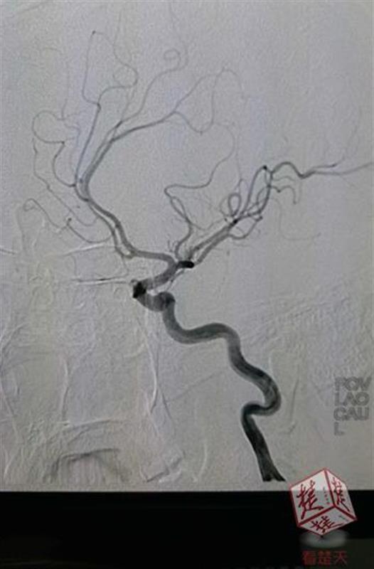 肥胖 脑血栓(肥胖脑血栓)