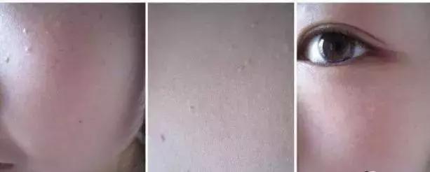 脂肪粒可以挤掉吗，脂肪粒可以手动挤出吗（小心与HPV病毒相关）